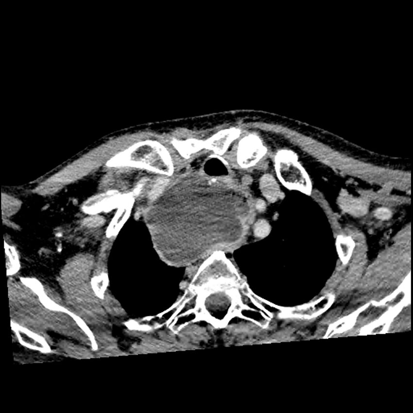 Anaplastic thyroid carcinoma (Radiopaedia 79087-92034 B 25).jpg