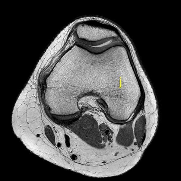 File:Anatomy Quiz (MRI knee) (Radiopaedia 43478-46866 A 11).jpeg