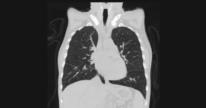 File:Angioinvasive aspergellosis (Radiopaedia 66995-76315 Coronal lung window 28).jpg