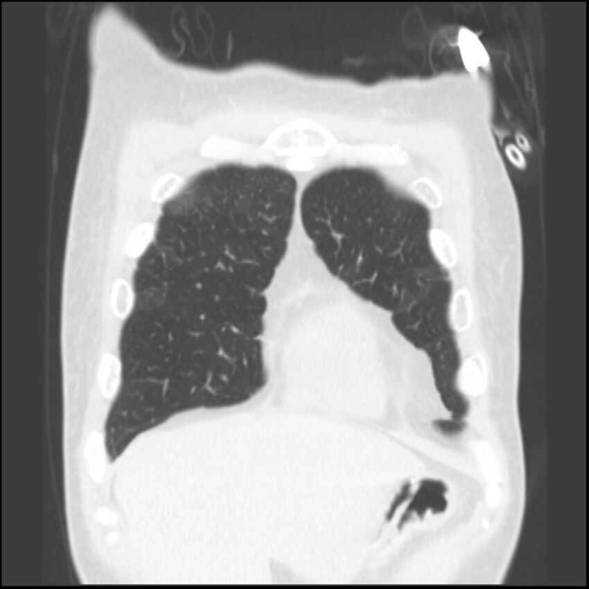 Angioinvasive aspergillosis (Radiopaedia 43957-47466 Coronal lung window 78).jpg