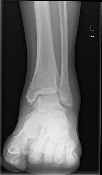 File:Anterior calcaneal process fracture (Radiopaedia 50110-55421 Oblique 1).jpg