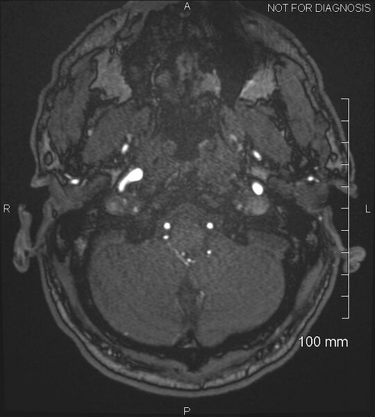 File:Anterior cerebral artery aneurysm (Radiopaedia 80683-94127 Axial MRA 19).jpg