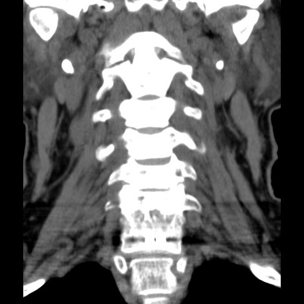 File:Anterior cervical postdiscectomy arthrodesis (Radiopaedia 32678-33646 Coronal non-contrast 11).jpg