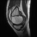Anterior cruciate ligament tear - pediatric (Radiopaedia 62152-70260 Sagittal PD 44).jpg