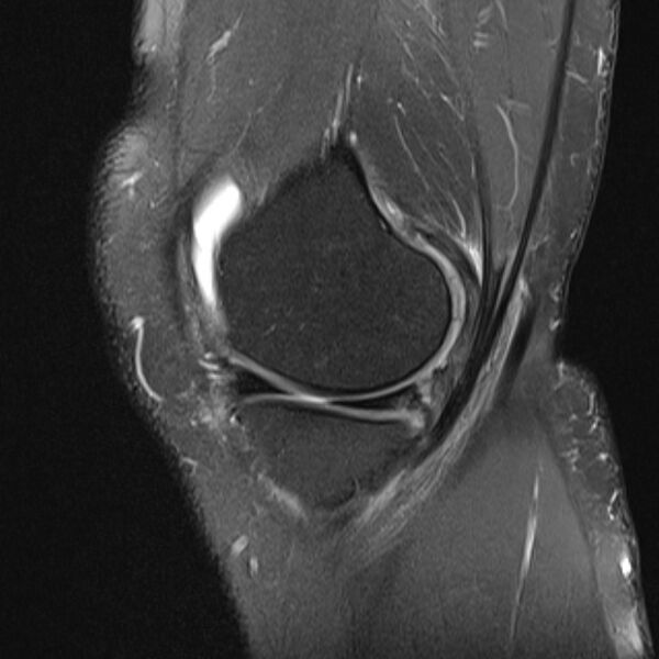 File:Anterior cruciate ligament tear - ramp lesion (Radiopaedia 71883-82322 Sagittal PD fat sat 20).jpg