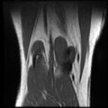 Anterior cruciate ligament tear with posteromedial corner injury, bucket-handle meniscal tear and chondral delamination (Radiopaedia 75501-86744 Coronal T1 23).jpg