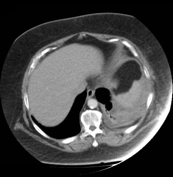 File:Aortic arch false aneurysm (Radiopaedia 14667-14588 A 18).jpg
