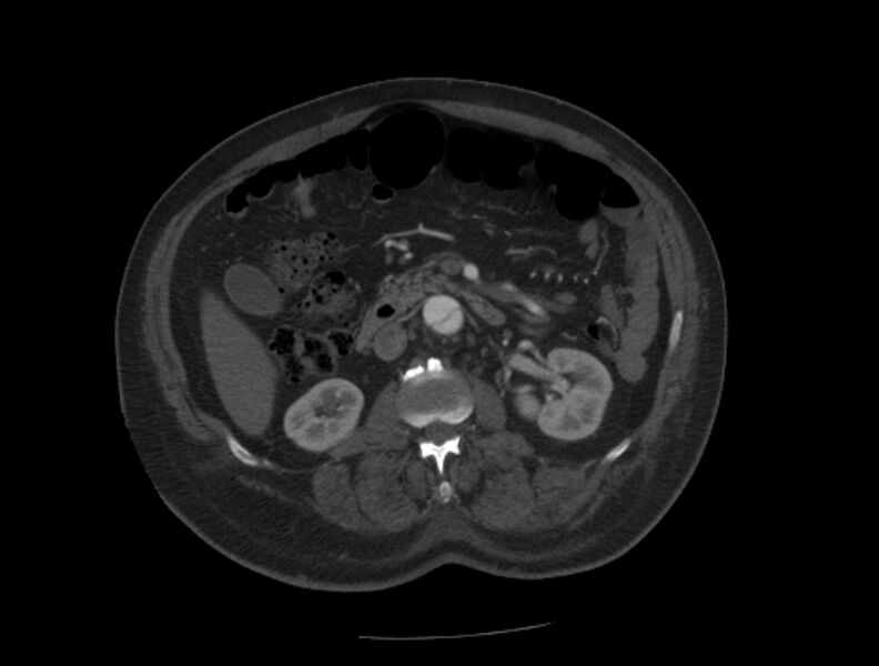 File:Aortic dissection (Radiopaedia 28802-29105 A 59).jpg