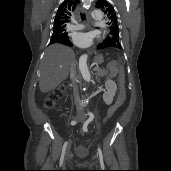 File:Aortic dissection (Radiopaedia 28802-29105 B 19).jpg