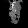 Aortic dissection (Radiopaedia 68763-78691 B 4).jpeg