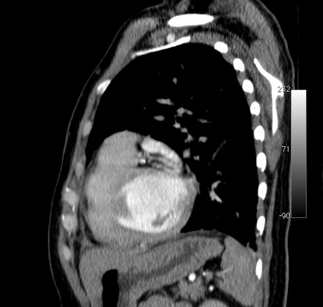 File:Aortic dissection - Stanford type A (Radiopaedia 29247-29659 C 11).jpg