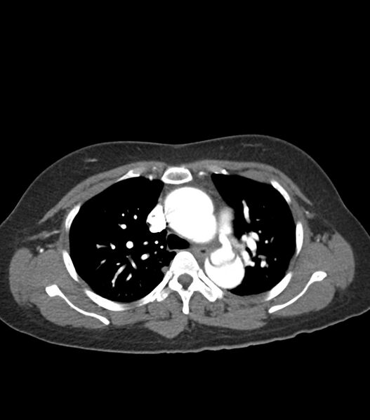 File:Aortic dissection with renal ischemia (Radiopaedia 76573-88338 A 19).jpg