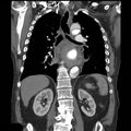 Aortic dissection with rupture into pericardium (Radiopaedia 12384-12647 B 28).jpg