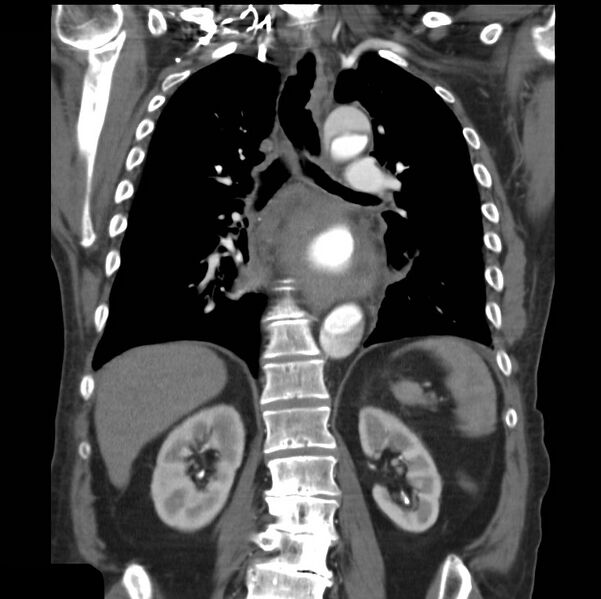 File:Aortic dissection with rupture into pericardium (Radiopaedia 12384-12647 B 28).jpg