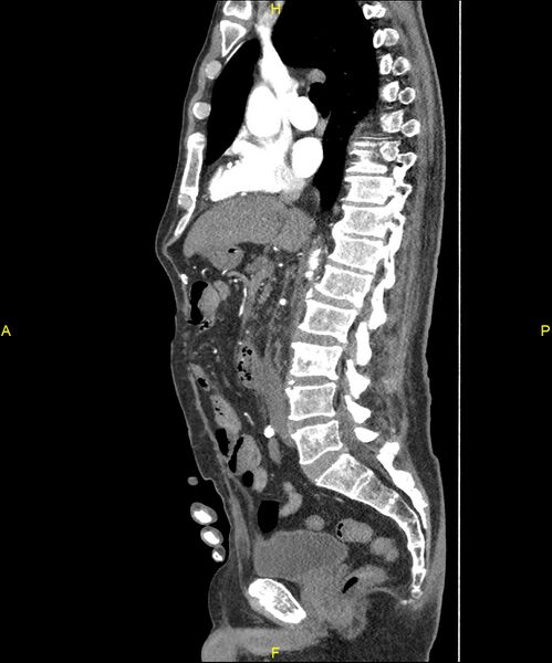 File:Aortoenteric fistula (Radiopaedia 84308-99603 C 165).jpg