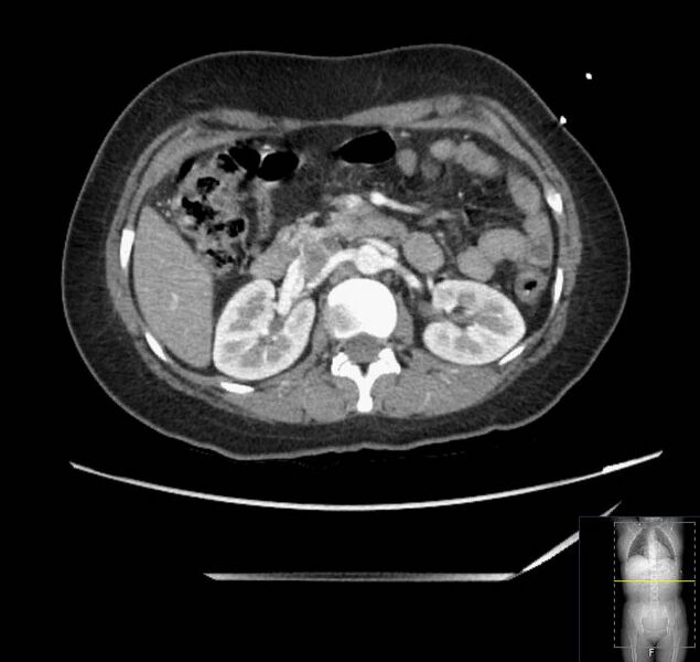 File:Appendicitis (CT angiogram) (Radiopaedia 154713-127660 Axial 119).jpg