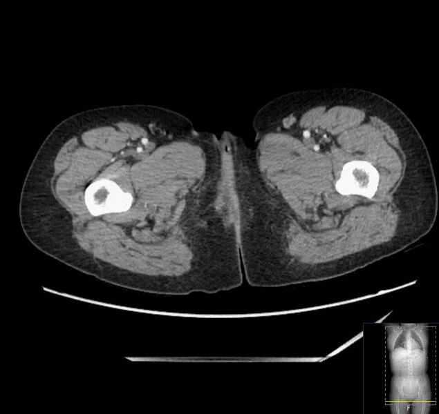 File:Appendicitis (CT angiogram) (Radiopaedia 154713-127660 Axial 120).jpg