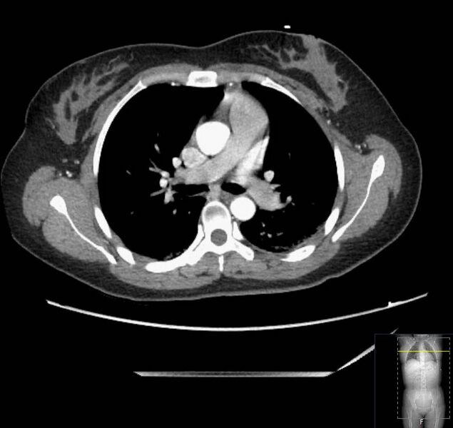 File:Appendicitis (CT angiogram) (Radiopaedia 154713-127660 Axial 207).jpg