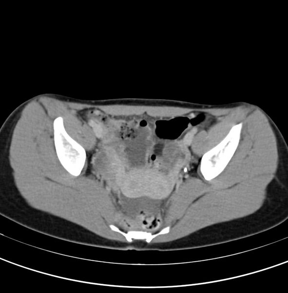File:Appendicitis and incidental bicornuate uterus (Radiopaedia 22833-22853 Axial C+ delayed 34).jpg