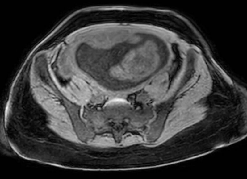 File:Appendicitis in gravida (MRI) (Radiopaedia 89433-106395 Axial DIXON 108).jpg