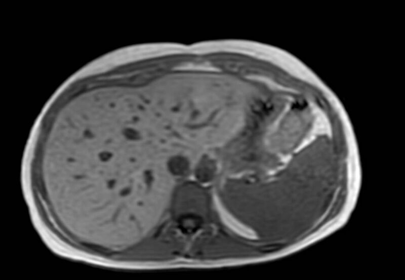 File:Appendicitis in gravida (MRI) (Radiopaedia 89433-106395 Axial T1 in-phase 9).jpg