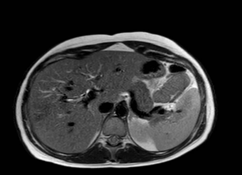 File:Appendicitis in gravida (MRI) (Radiopaedia 89433-106395 Axial T2 12).jpg