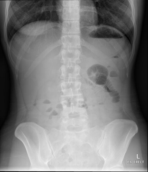 File:Appendicitis with minimal stranding but appendicolith (Radiopaedia 29035-29398 Abdomen PA Erect 1).jpg