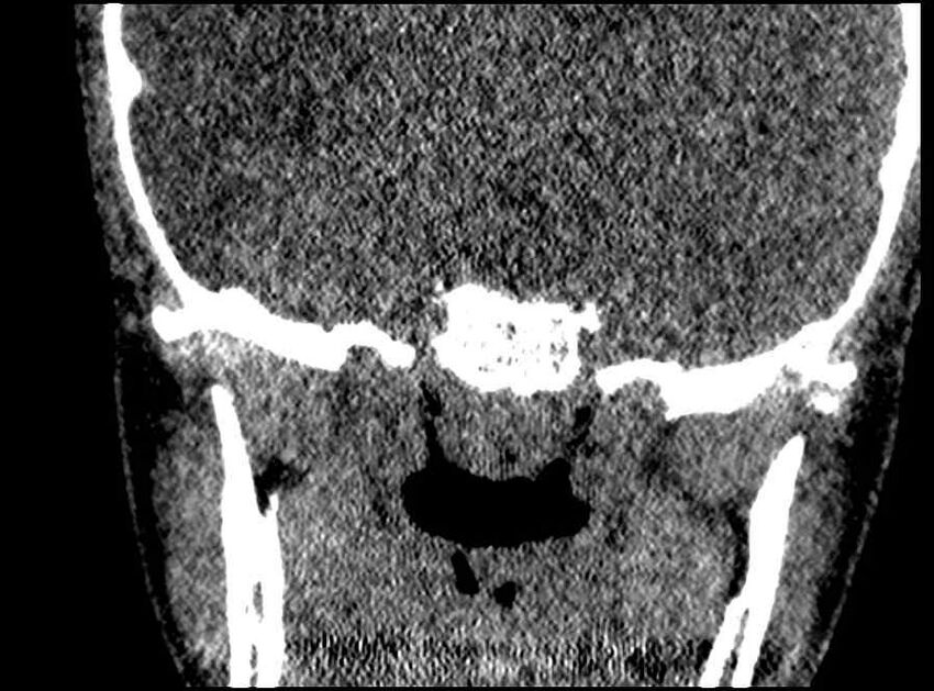Arachnoid cyst- extremely large (Radiopaedia 68741-78450 Coronal bone window 3).jpg