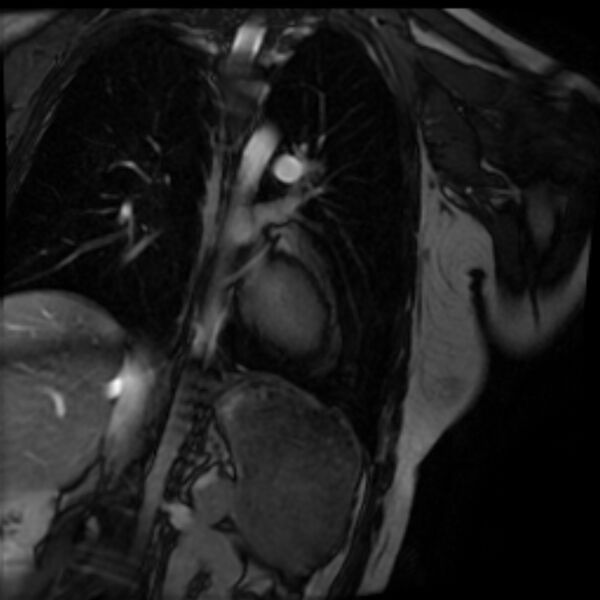 File:Arrhythmogenic right ventricular cardiomyopathy (Radiopaedia 87505-103850 2ch (LV) Cine SSFP 67).jpg