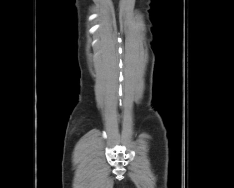 File:Arterial occlusive mesenteric ischemia (Radiopaedia 84641-100060 B 53).jpg