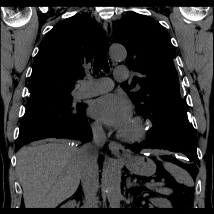 Asbestos-related pleural plaques (Radiopaedia 39069-41255 Coronal non-contrast 43).jpg