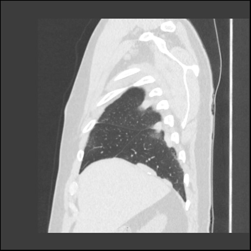 Asbestosis (Radiopaedia 45002-48961 Sagittal lung window 117).jpg