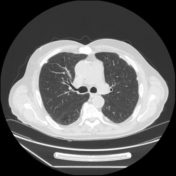 File:Asbestosis complicated by lung cancer (Radiopaedia 45834-50116 Axial lung window 28).jpg