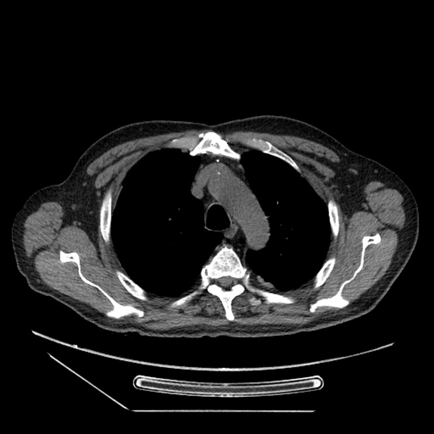 Asbestosis complicated by lung cancer (Radiopaedia 45834-50116 Axial non-contrast 15).jpg