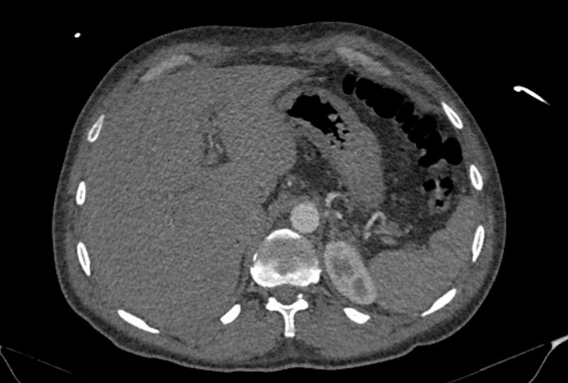 File:Ascending aortic aneurysm (Radiopaedia 86279-102297 C 66).jpg