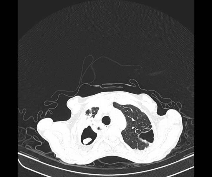 File:Aspergillomas (Radiopaedia 66779-76110 Axial lung window 16).jpg