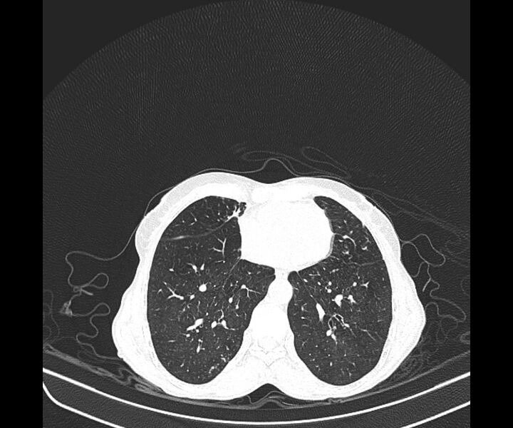 File:Aspergillomas (Radiopaedia 66779-76110 Axial lung window 32).jpg