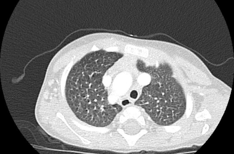 File:Asplenia syndrome (Radiopaedia 73083-83792 Axial lung window 14).jpg