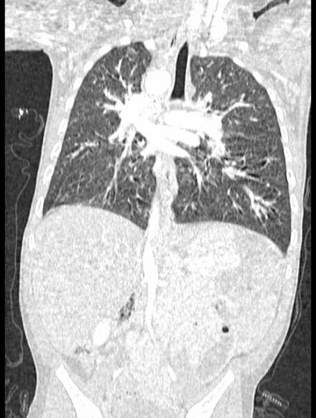 File:Asplenia syndrome (Radiopaedia 73083-83792 Coronal lung window 81).jpg