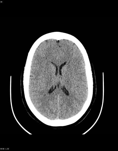 File:Astroblastoma (Radiopaedia 39792-42216 Axial non-contrast 29).jpg