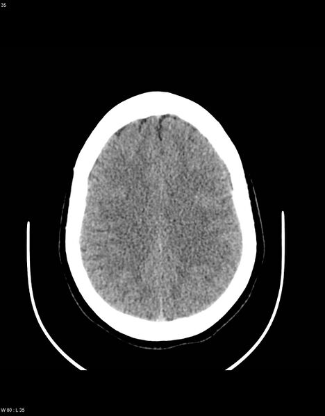 File:Astroblastoma (Radiopaedia 39792-42216 Axial non-contrast 34).jpg