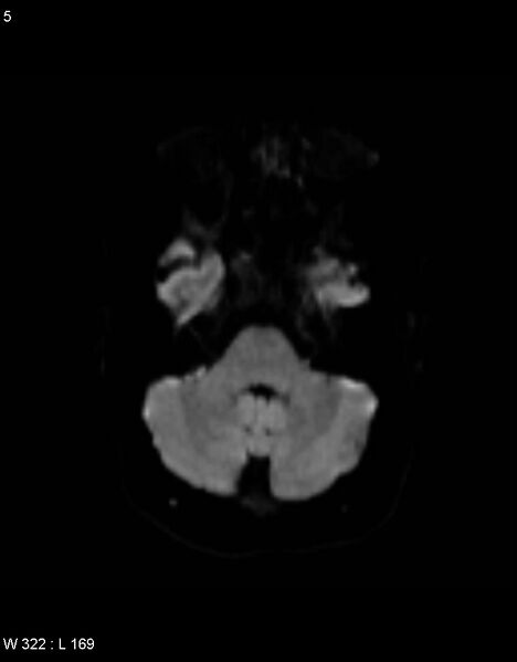 File:Astroblastoma (Radiopaedia 39792-42217 Axial DWI 4).jpg