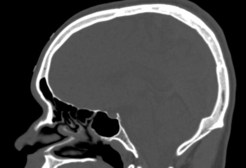 Asymptomatic occipital spur (Radiopaedia 87753-104201 Sagittal bone window 159).jpg
