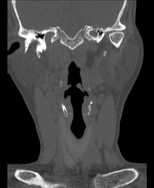 File:Atlanto-occipital assimilation with basilar invagination (Radiopaedia 70122-80188 Coronal bone window 23).jpg