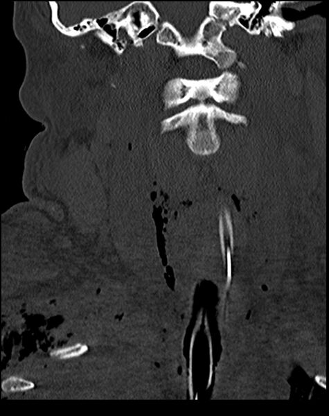 File:Atlanto-occipital dissociation - Traynelis type 1 (Radiopaedia 87570-103948 Coronal bone window 25).jpg