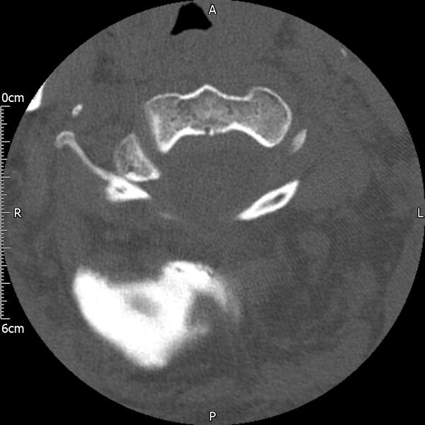 File:Atlas fracture with Currarino type A congenital defect (Radiopaedia 71747-82144 Axial bone window 46).jpg