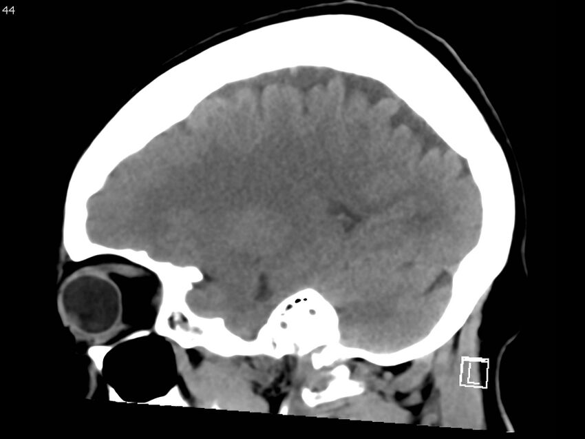 Atypical meningioma - intraosseous (Radiopaedia 64915-73867 C 42).jpg