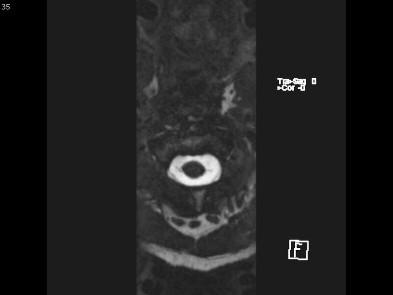 File:Atypical meningioma - intraosseous (Radiopaedia 64915-74572 Axial CISS 35).jpg