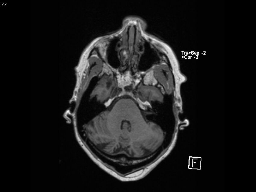 Atypical meningioma - intraosseous (Radiopaedia 64915-74572 Axial T1 77).jpg