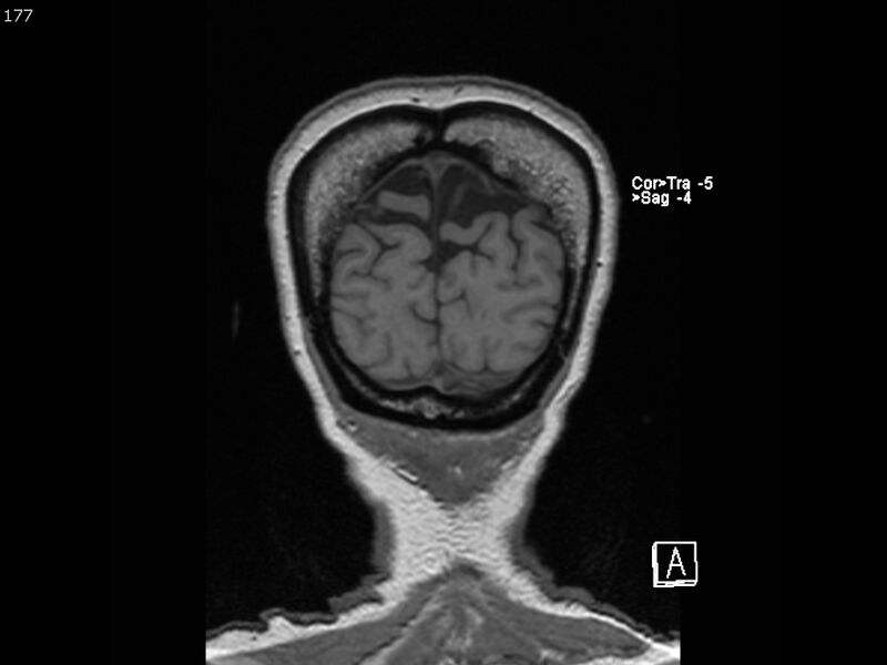File:Atypical meningioma - intraosseous (Radiopaedia 64915-74572 Coronal T1 177).jpg